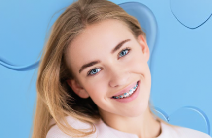 Установка брекет-системы<br> BIOMIM